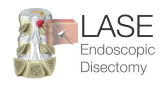 LASE Endoscopic Disectomy
